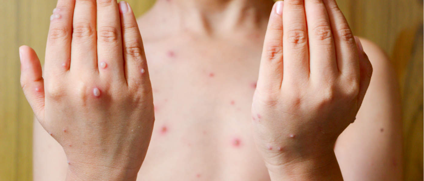 chicken pox rash pictures early stages